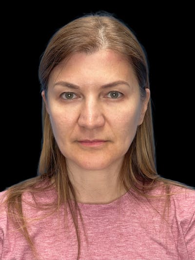 Deep Plane Facelift 50s Before & After Gallery - Patient 194849 - Image 1