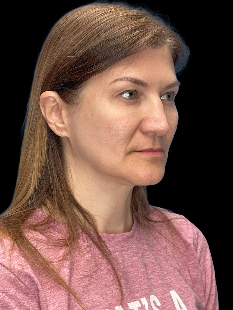 Deep Plane Facelift 50s Before & After Gallery - Patient 194849 - Image 3