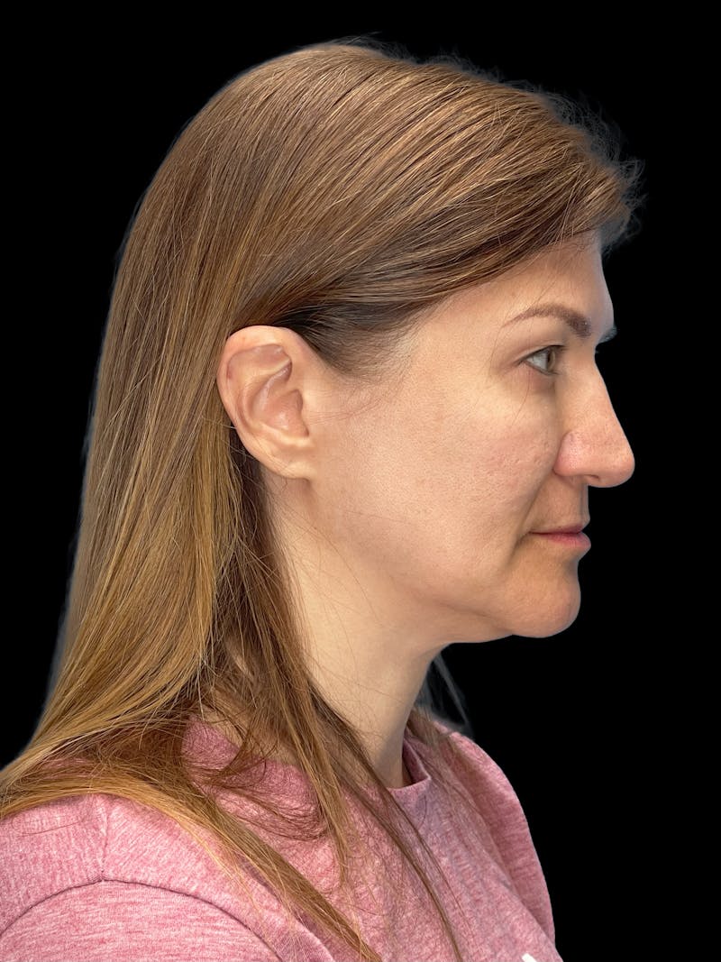 Deep Plane Facelift 50s Before & After Gallery - Patient 194849 - Image 5