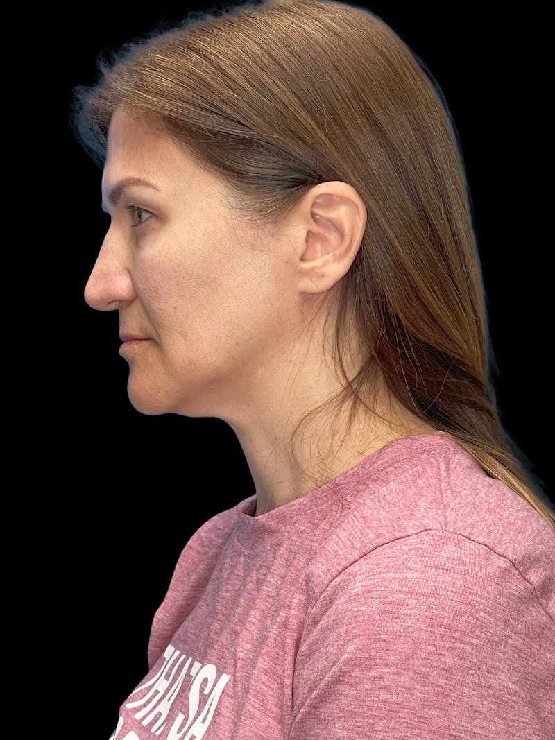 Deep Plane Facelift 50s Before & After Gallery - Patient 194849 - Image 11