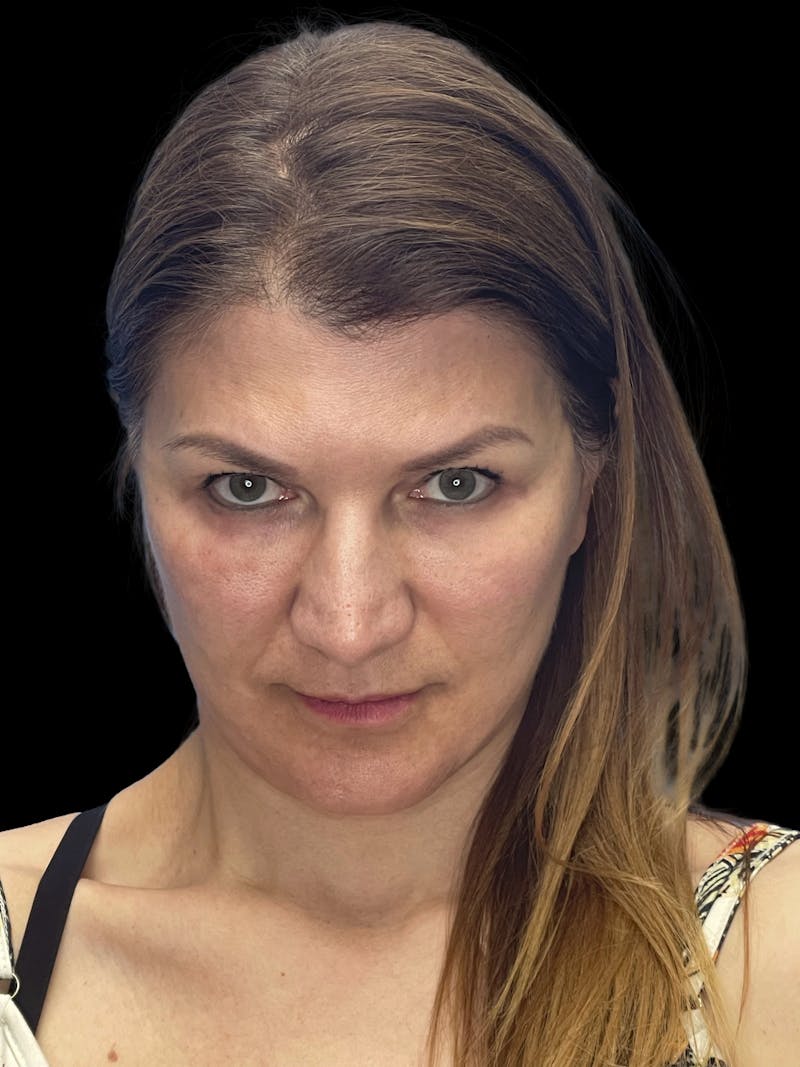Deep Plane Facelift 50s Before & After Gallery - Patient 194849 - Image 8