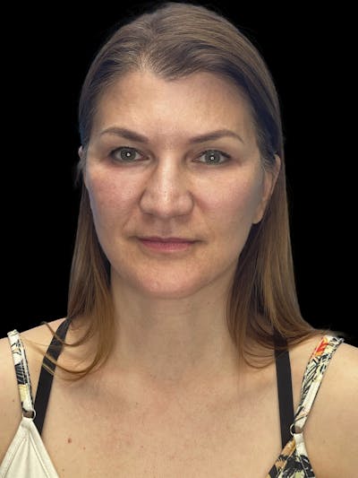 Deep Plane Facelift 50s Before & After Gallery - Patient 194849 - Image 2