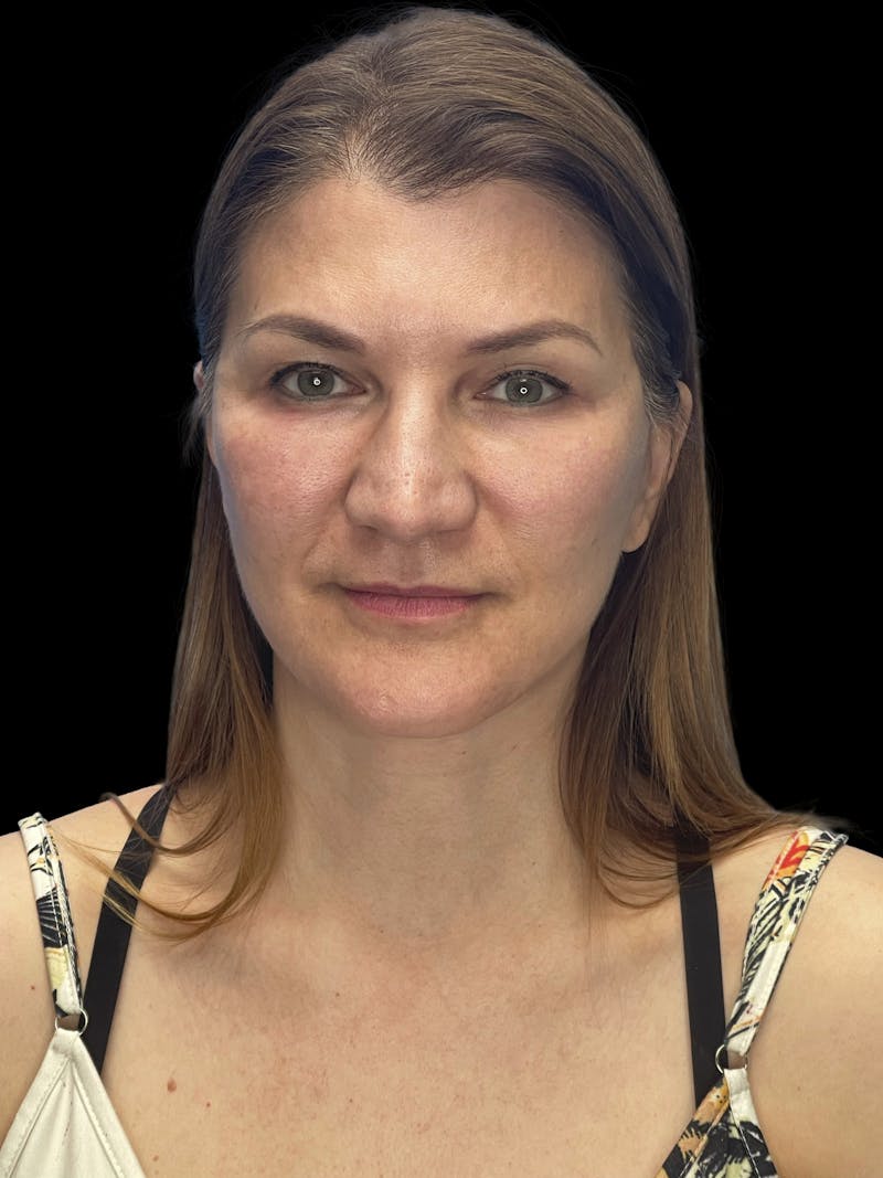 Deep Plane Facelift 50s Before & After Gallery - Patient 194849 - Image 2