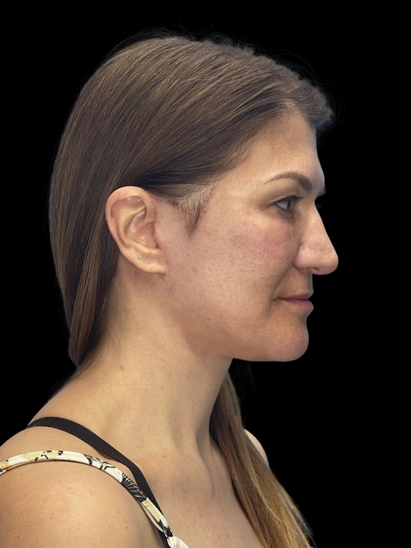 Deep Plane Facelift 50s Before & After Gallery - Patient 194849 - Image 6
