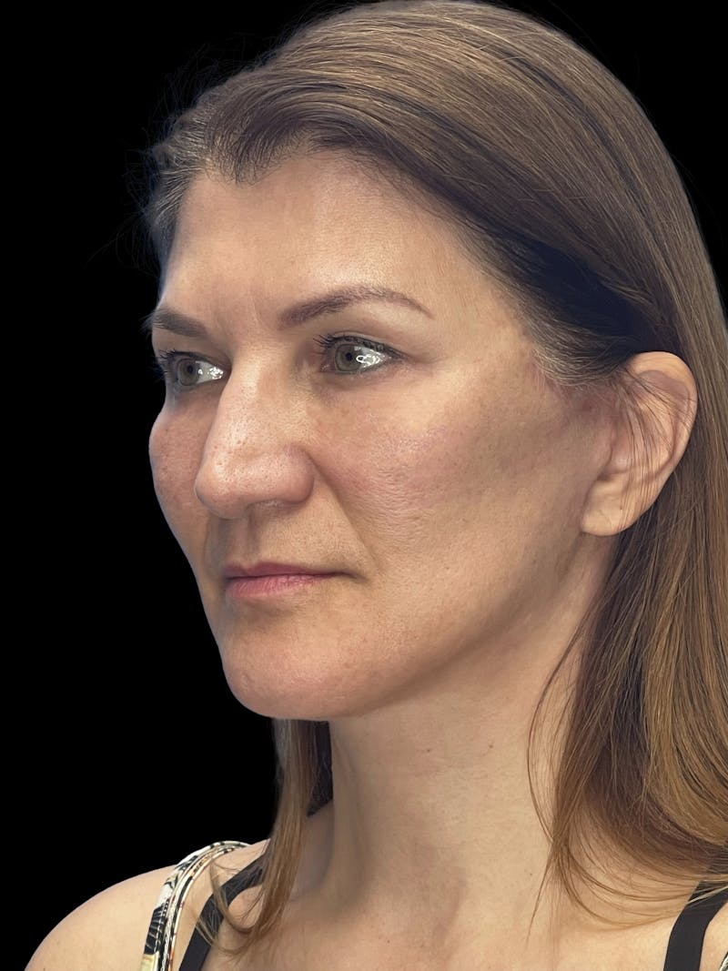 Deep Plane Facelift 50s Before & After Gallery - Patient 194849 - Image 10