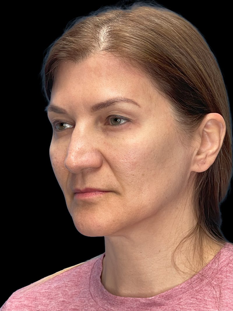 Deep Plane Facelift 50s Before & After Gallery - Patient 194849 - Image 9