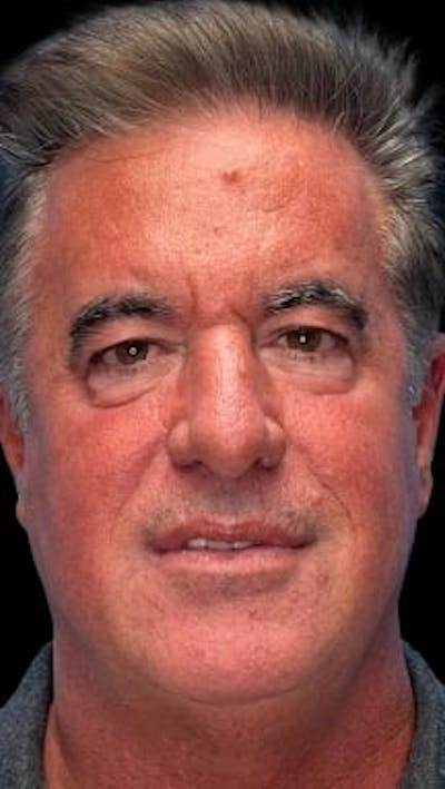 Blepharoplasty LP Before & After Gallery - Patient 261899 - Image 1