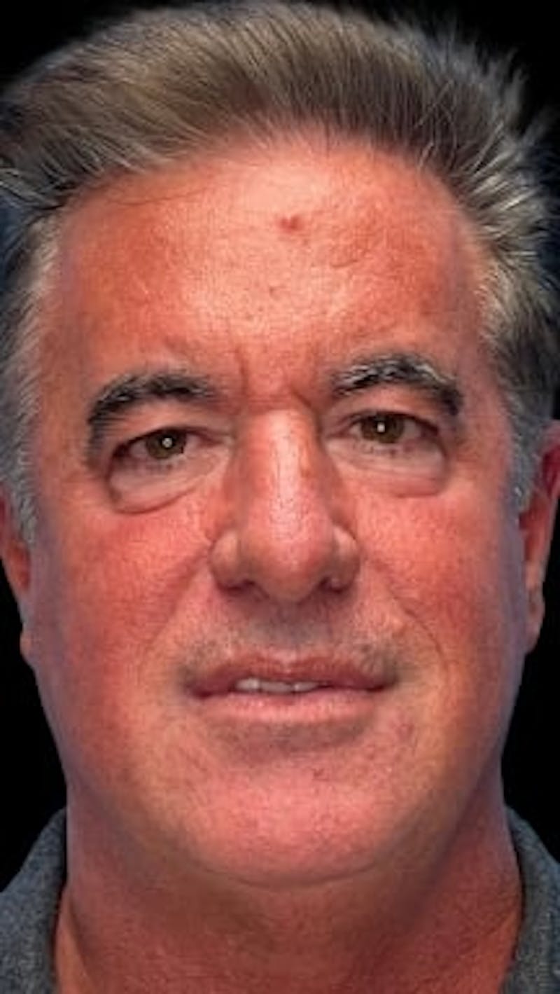 Blepharoplasty LP Before & After Gallery - Patient 261899 - Image 1