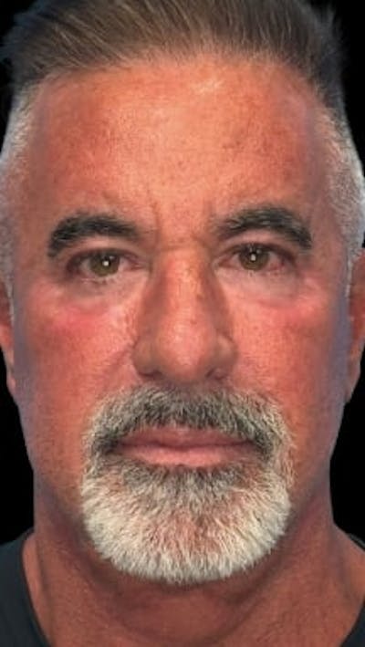 Blepharoplasty LP Before & After Gallery - Patient 261899 - Image 2