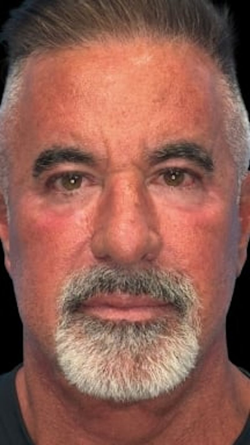 Blepharoplasty LP Before & After Gallery - Patient 261899 - Image 2