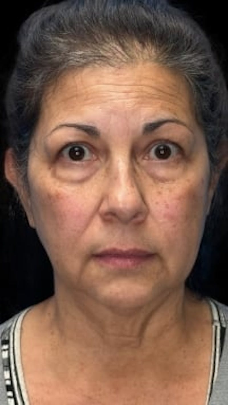 Blepharoplasty LP Before & After Gallery - Patient 245053 - Image 1