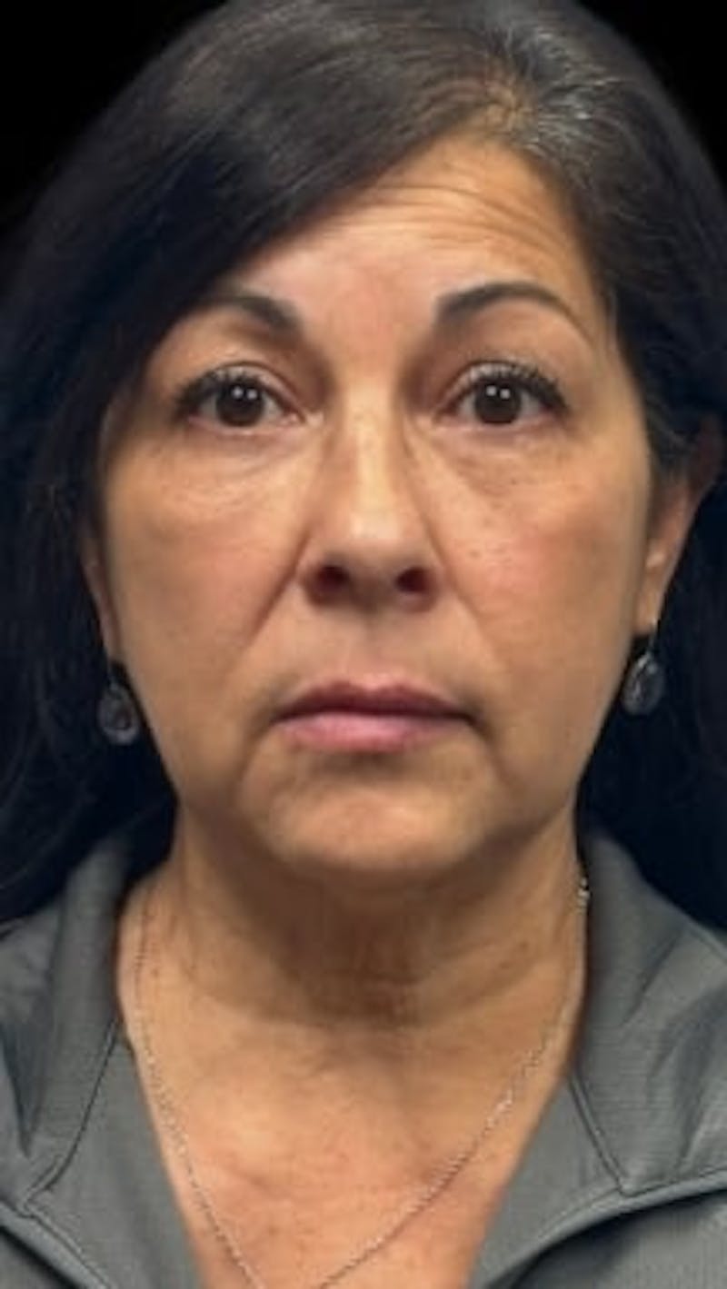 Blepharoplasty LP Before & After Gallery - Patient 245053 - Image 2