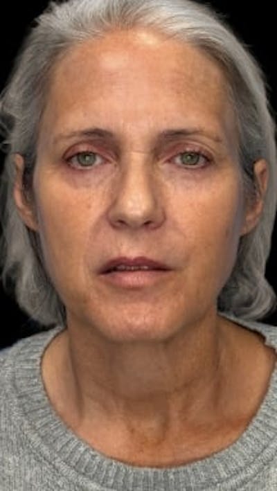 Blepharoplasty LP Before & After Gallery - Patient 415888 - Image 1