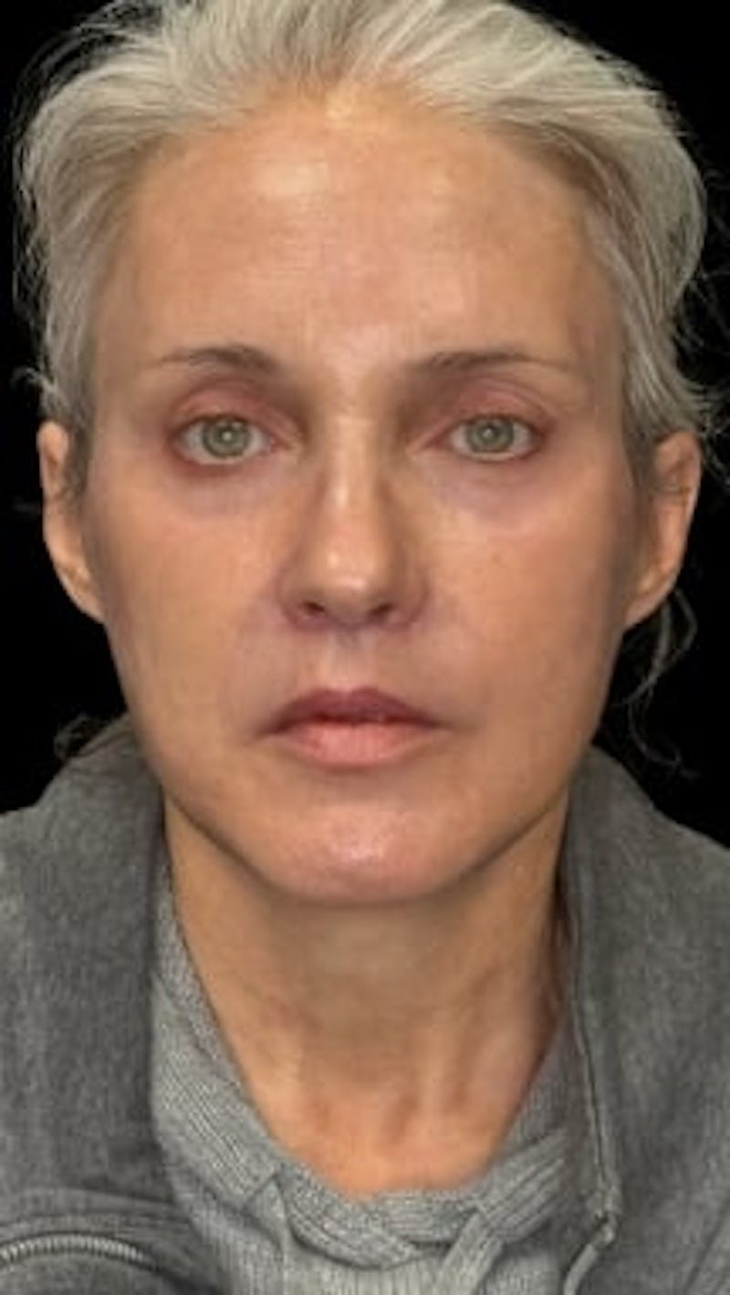 Blepharoplasty LP Before & After Gallery - Patient 415888 - Image 2