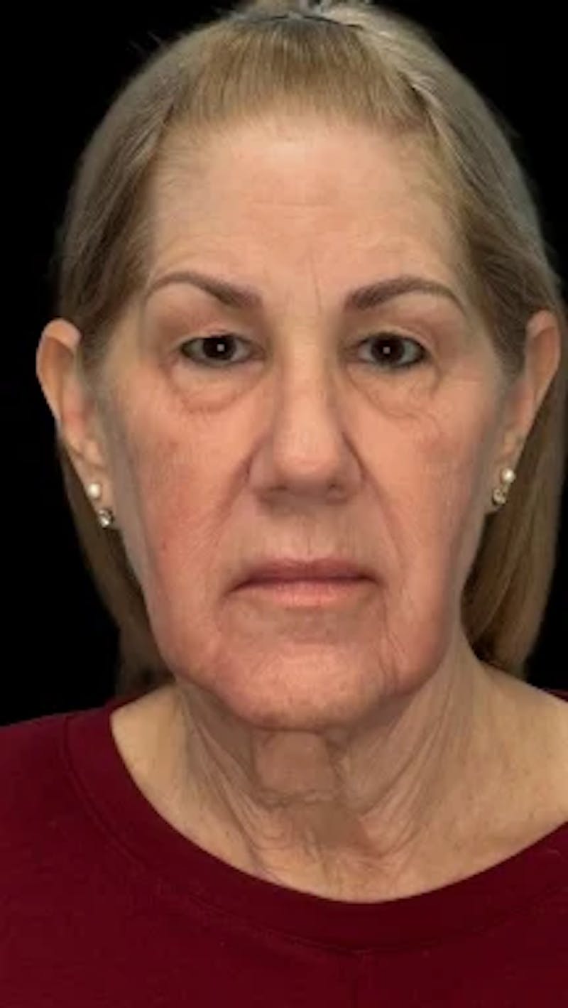Blepharoplasty LP Before & After Gallery - Patient 310798 - Image 1