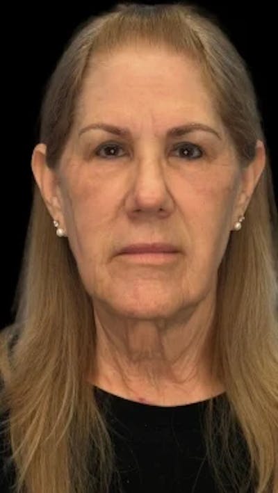 Blepharoplasty LP Before & After Gallery - Patient 310798 - Image 2