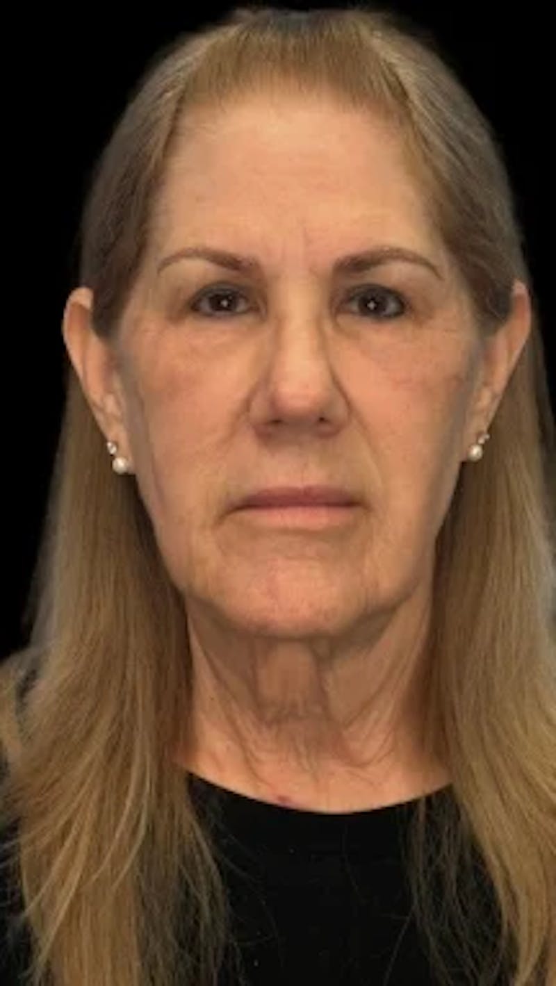 Blepharoplasty LP Before & After Gallery - Patient 310798 - Image 2