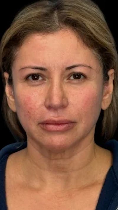 Blepharoplasty LP Before & After Gallery - Patient 340208 - Image 1