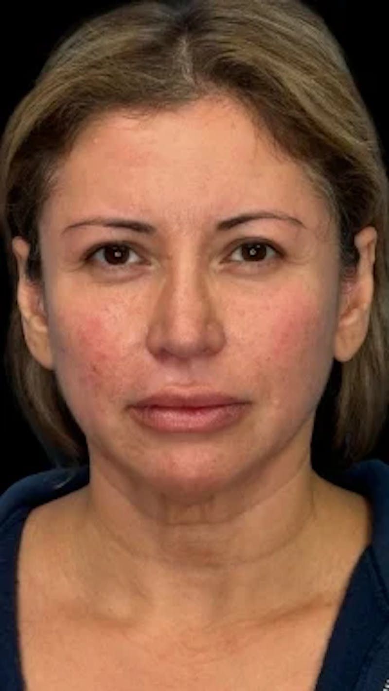 Blepharoplasty LP Before & After Gallery - Patient 340208 - Image 1