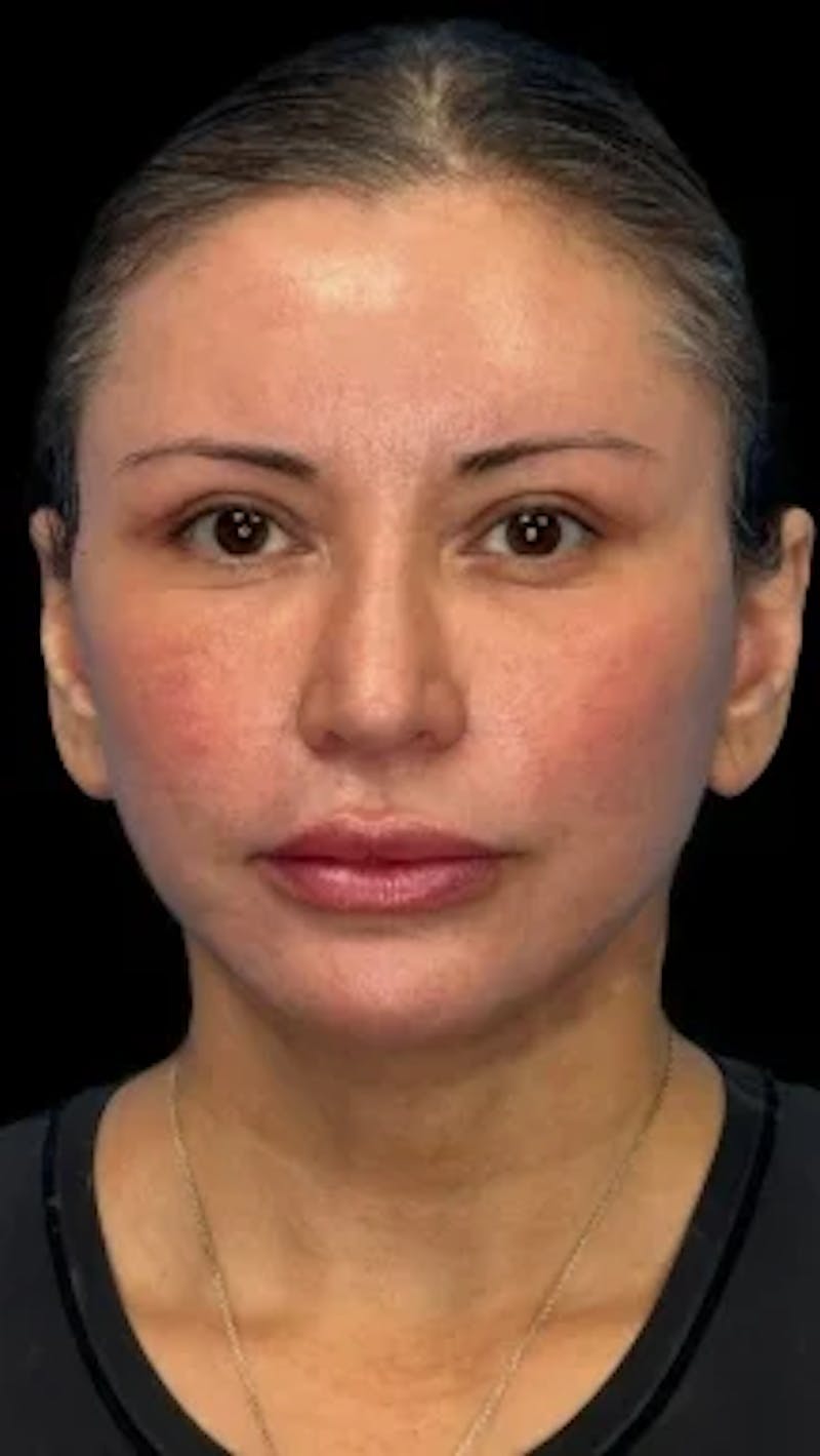 Blepharoplasty LP Before & After Gallery - Patient 340208 - Image 2