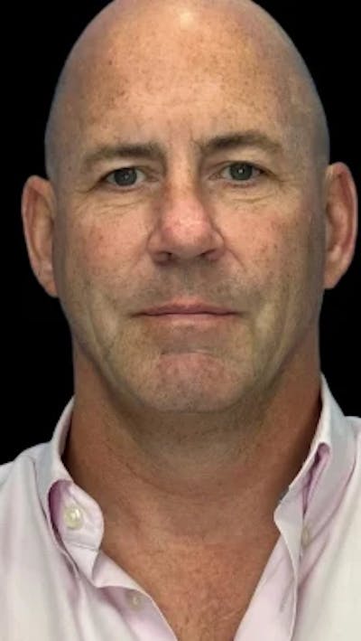 Blepharoplasty LP Before & After Gallery - Patient 209579 - Image 1