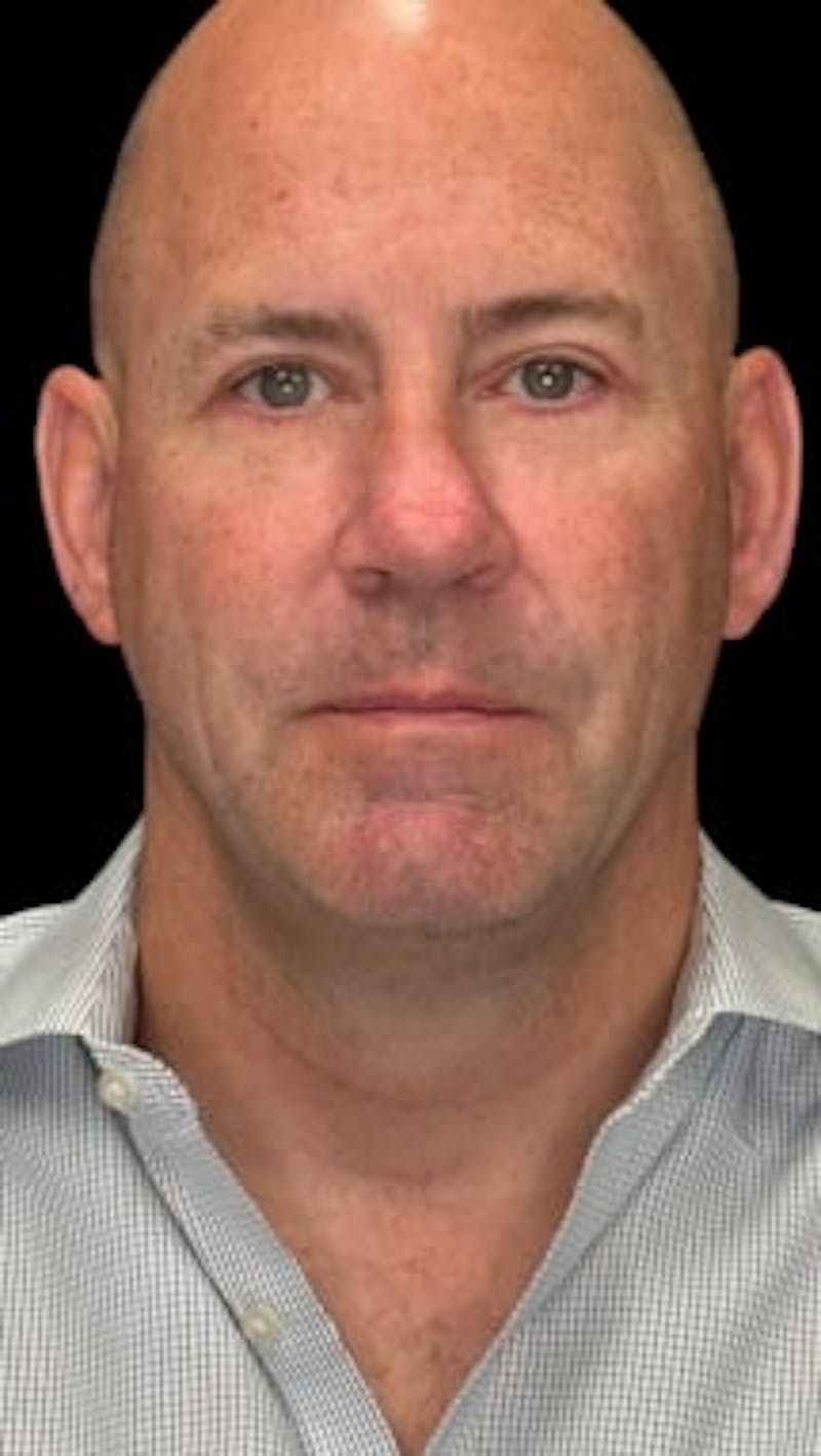 Blepharoplasty LP Before & After Gallery - Patient 209579 - Image 2