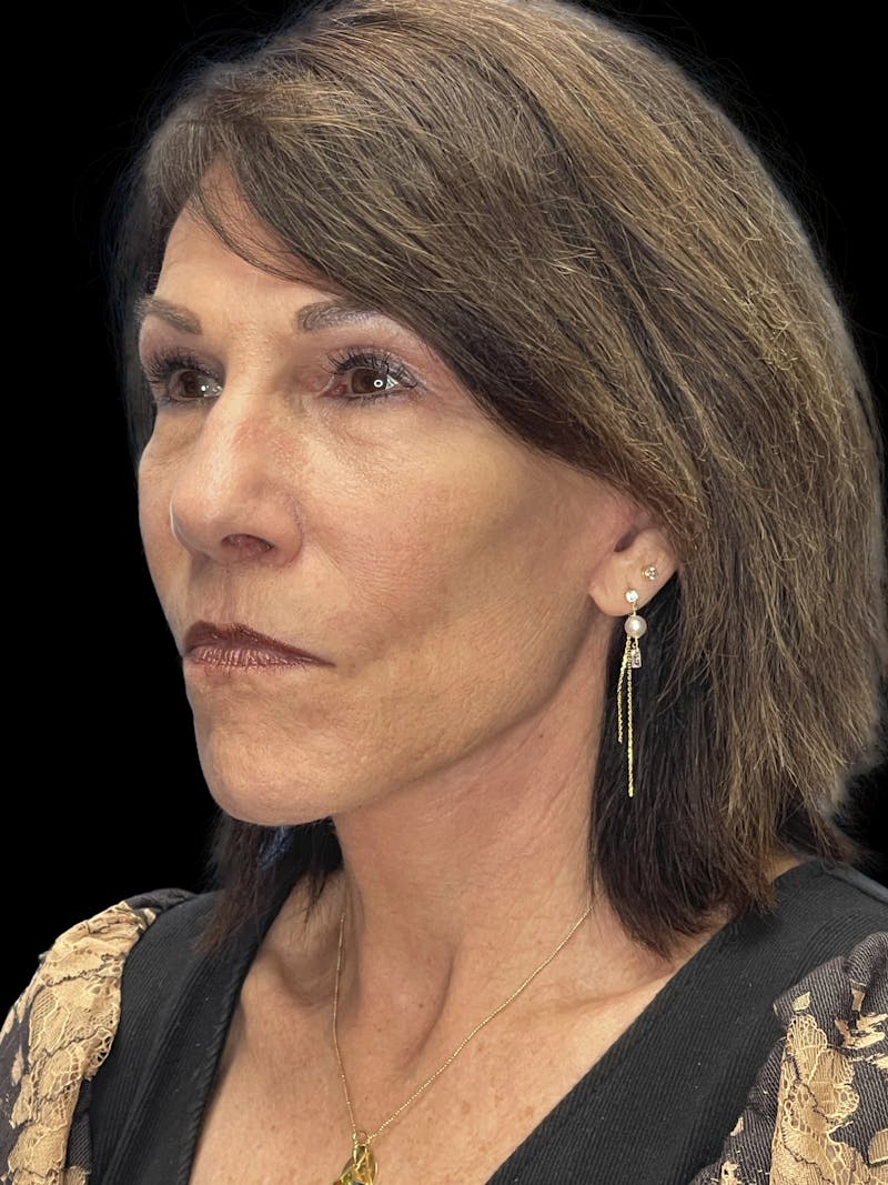 ContourLift Before & After Gallery - Patient 132623 - Image 8