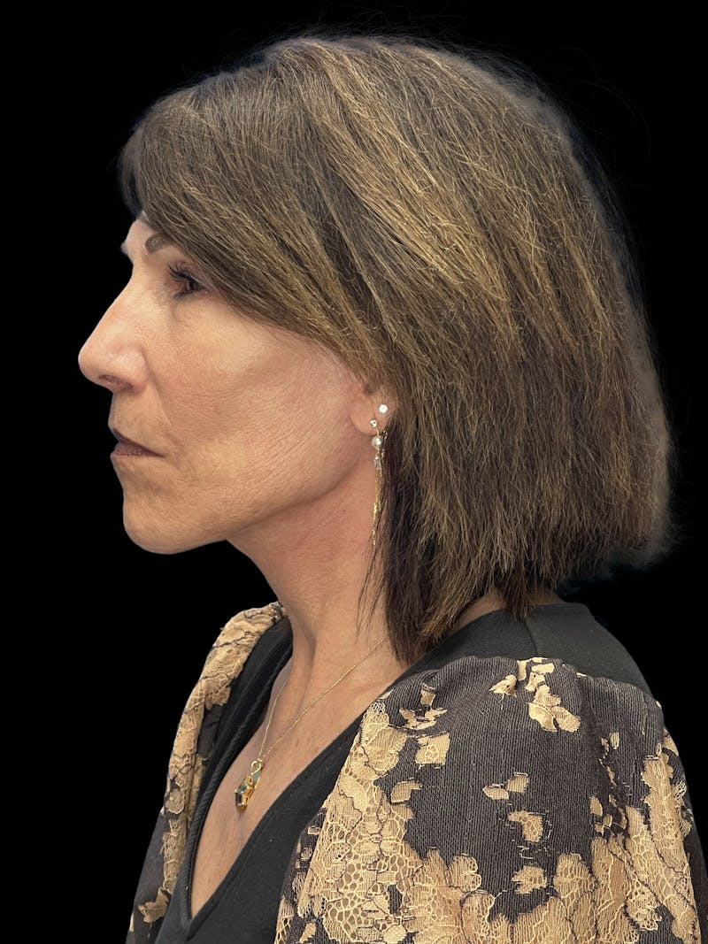 ContourLift Before & After Gallery - Patient 132623 - Image 10