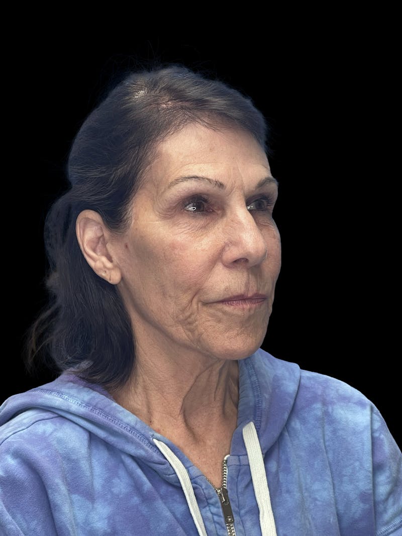 ContourLift Before & After Gallery - Patient 132623 - Image 3