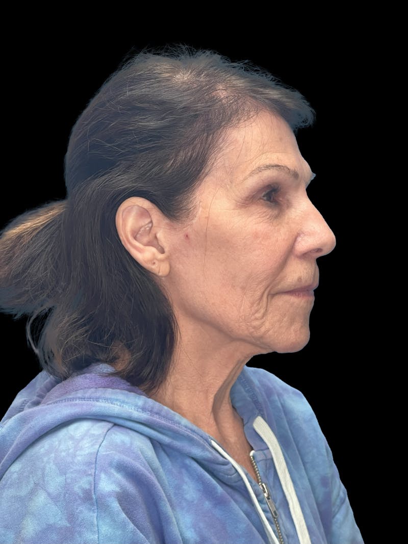 ContourLift Before & After Gallery - Patient 132623 - Image 5