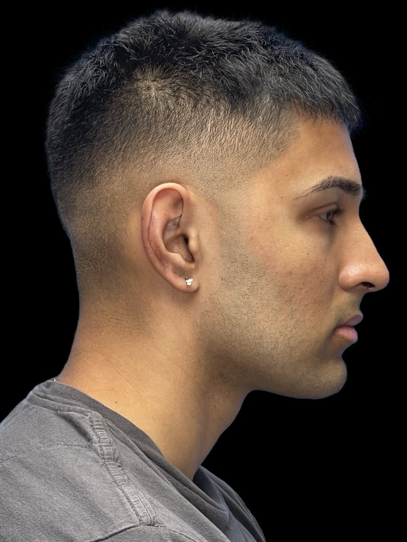 Custom Wrap Implants Before & After Gallery - Patient 475334 - Image 9