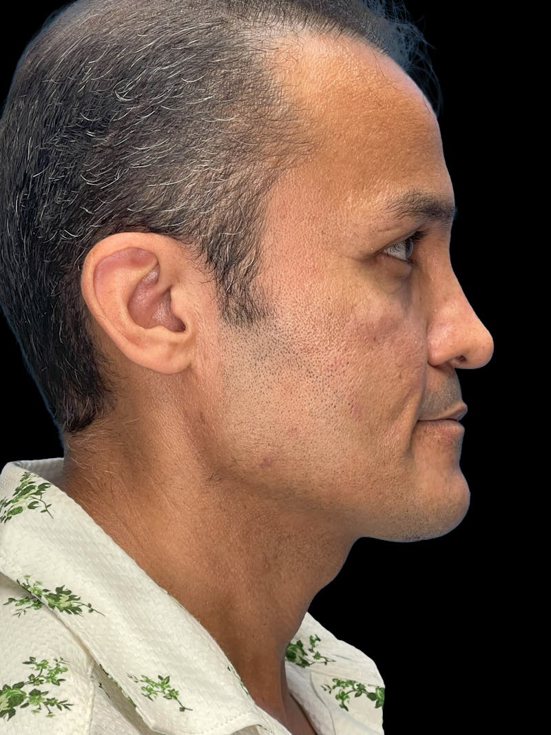 Custom Wrap Implants Before & After Gallery - Patient 534394 - Image 4