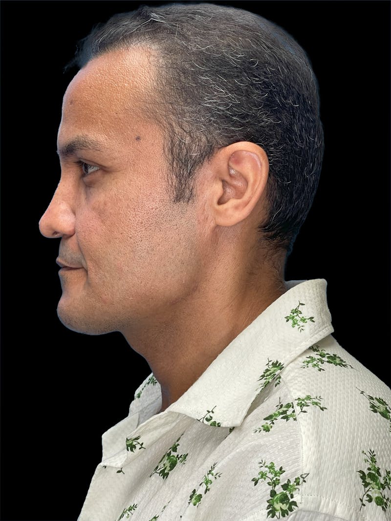 Custom Wrap Implants Before & After Gallery - Patient 534394 - Image 10