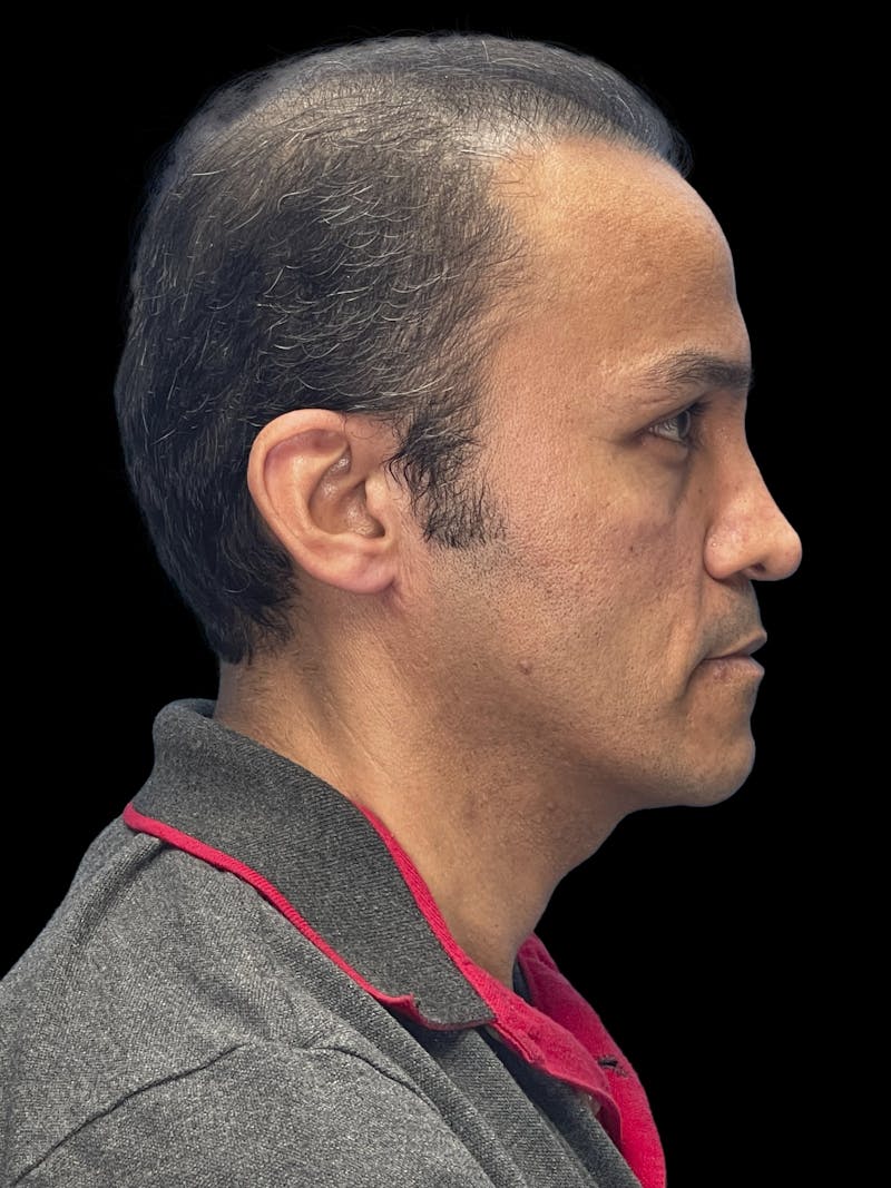 Custom Wrap Implants Before & After Gallery - Patient 534394 - Image 3