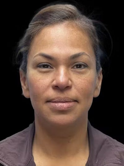 Deep Plane Facelift 40s Before & After Gallery - Patient 267273 - Image 1