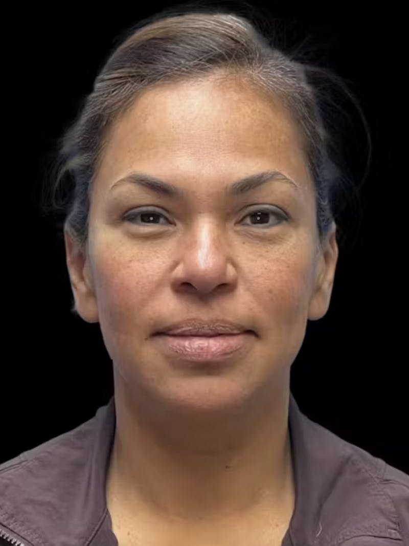 Deep Plane Facelift 40s Before & After Gallery - Patient 267273 - Image 1