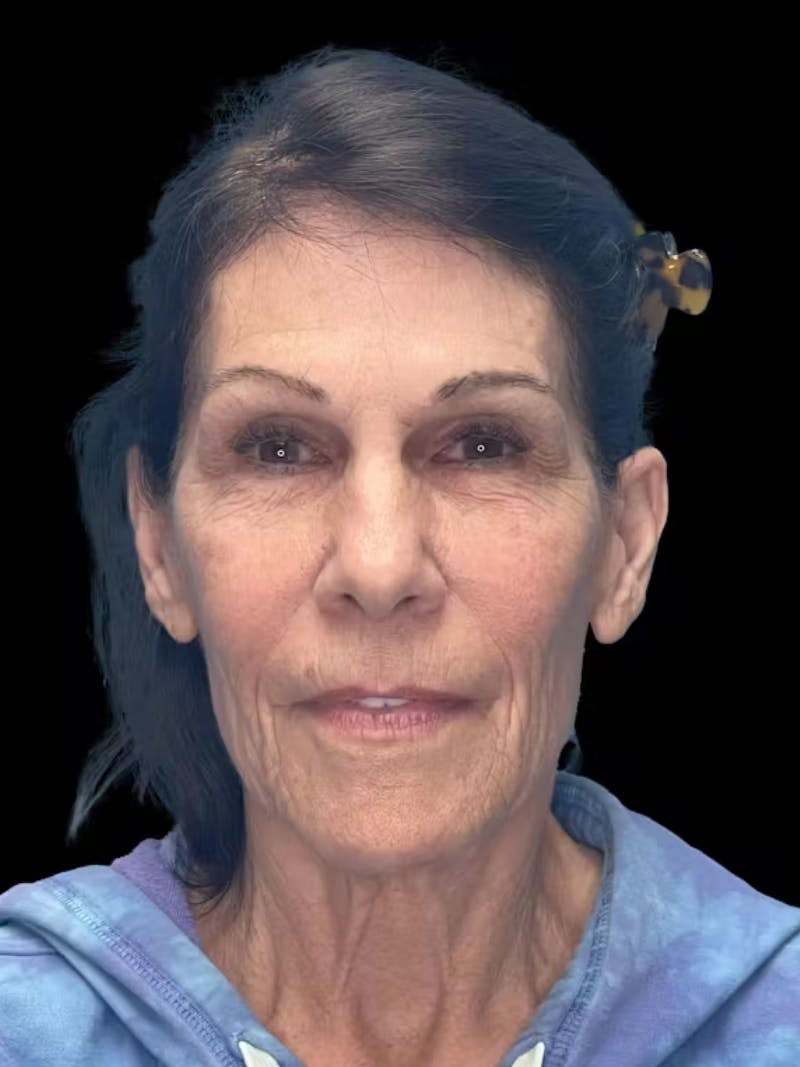 ContourLift Before & After Gallery - Patient 132623 - Image 1