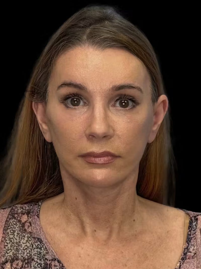Deep Plane Facelift 50s Before & After Gallery - Patient 121791 - Image 2