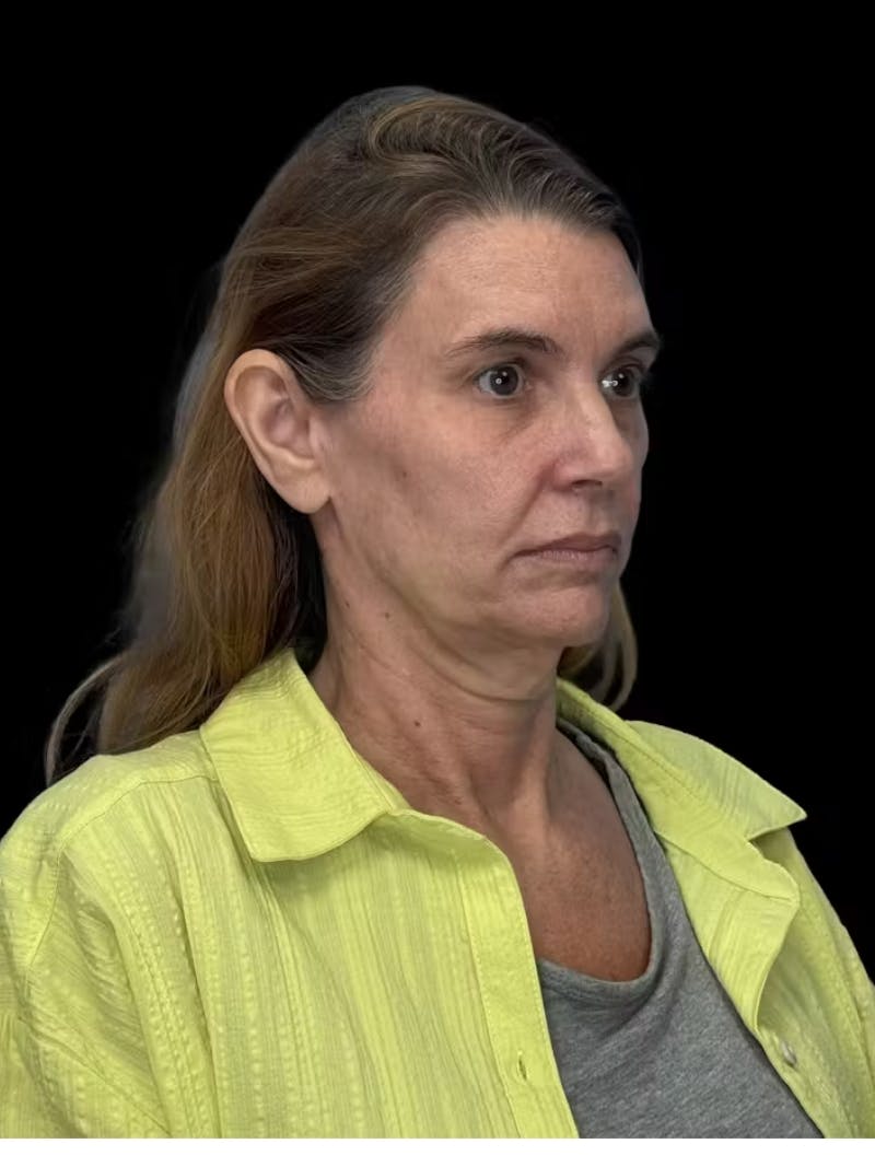 Deep Plane Facelift 50s Before & After Gallery - Patient 121791 - Image 3
