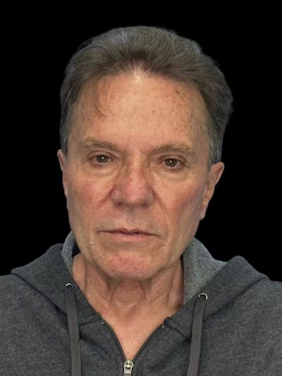 Deep Plane Facelift 60s Before & After Gallery - Patient 105712 - Image 1