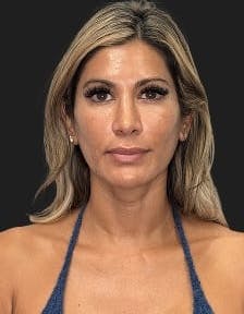 Plastic surgery patient photo