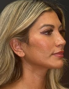 Plastic surgery patient photo