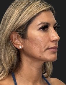 Plastic surgery patient photo