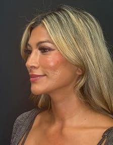 Plastic surgery patient photo