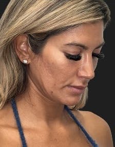 Plastic surgery patient photo