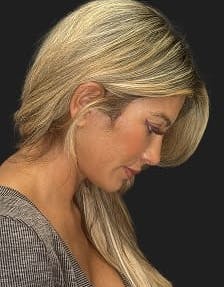 Plastic surgery patient photo