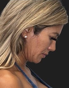 Plastic surgery patient photo