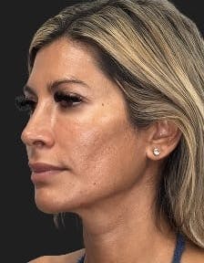 Plastic surgery patient photo