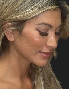 Plastic surgery patient photo