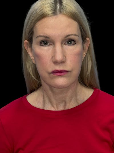 Brow Lift Before & After Gallery - Patient 350884 - Image 2